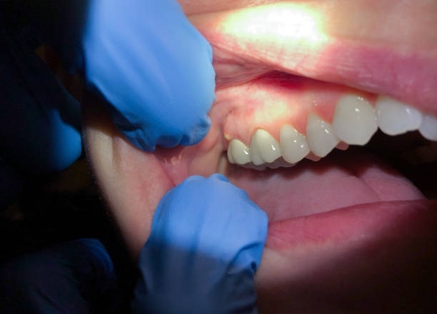 Best Emergency Tooth Extraction in Saucier, MS